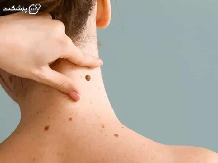 خارش خالهای قهوهای-پزشکت